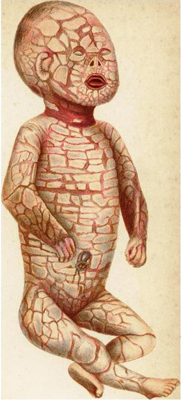 Harlequin ichthyosis